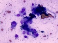 Melanoma