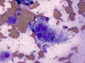 Multinucleated giant cell with melanin