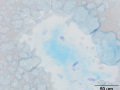 Mucin-producing sarcoma (alcian blue)