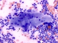 Neutrophilic inflammation & muscle