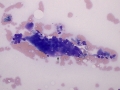 Sarcoma with giant cells (cat)