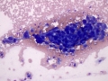 Suspect hemangiosarcoma (dog)