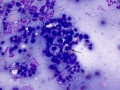 Neutrophilic inflammation & sebocytes