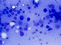Cutaneous plasmacytosis (rapid stain)