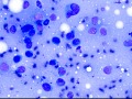 Cutaneous plasmacytosis (rapid stain)