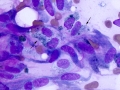 Keloidal fibroma/fibrosarcoma (DQ, dog)