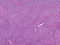 Granular cell trichoblastoma (H&E, dog)