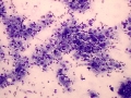 Xanthoma