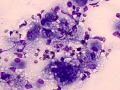 Xanthoma