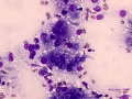 Xanthoma