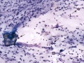 Broncholithiasis