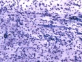 Broncholithiasis