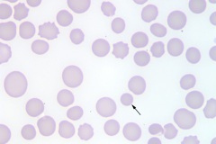 Acute leukemia