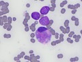 Phaeochromocytoma