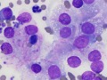 Phaeochromocytoma