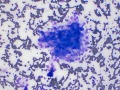 Phaeochromocytoma
