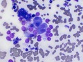 Phaeochromocytoma