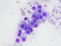Phaeochromocytoma