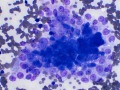 Phaeochromocytoma