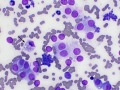 Phaeochromocytoma