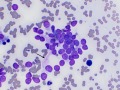 Phaeochromocytoma