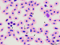 Dysplasia
