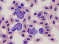 Acute lymphoid leukemia (peahen)