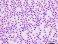Chronic lymphocytic leukemia (conure)