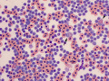 Chronic lymphocytic leukemia (CLL, duck)