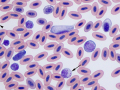 Hawk: Reactive & granular lymphocytes
