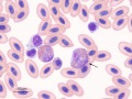 Toxic heterophil (pigeon)