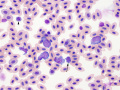 Acute lymphoid leukemia (peahen)