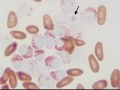 Myeloid leukemia (MPx)