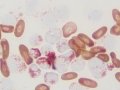 Myeloid leukemia (MPx)