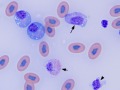 Lymphoid leukemia