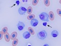 Lymphoid leukemia