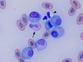Lymphoid leukemia