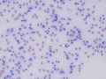 Lymphoid leukemia