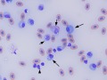 Lymphoid leukemia