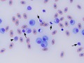 Lymphoid leukemia