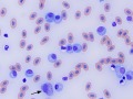 Lymphoid leukemia