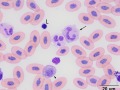 Band heterophil & polychromatophil