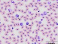 Inflammation