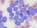 Myeloid leukemia