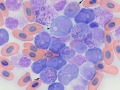 Myeloid leukemia