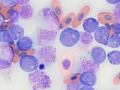 Myeloid leukemia