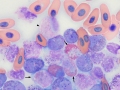 Myeloid leukemia