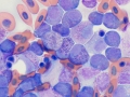 Myeloid leukemia