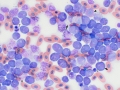 Myeloid leukemia