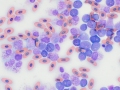 Myeloid leukemia